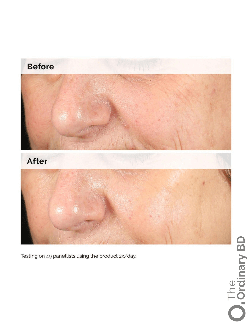 AHA 30% + BHA 2% Peeling Solution